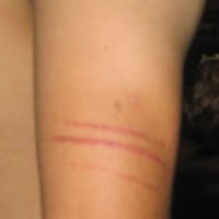Arm Lacerations