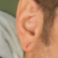 Ear Laceration