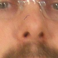 Face Lacerations