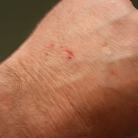 Hand Lacerations